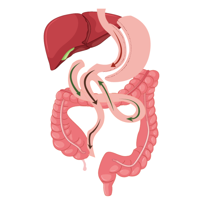 SIPS Surgery (SADI-S Surgery) | Perth Weight Loss & Surgery
