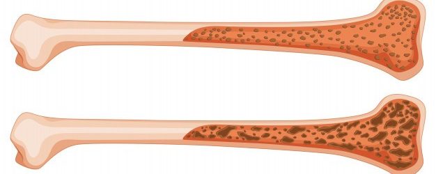Osteoporosis After Weight Loss Surgery