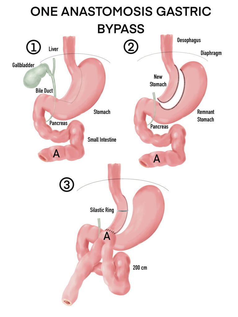 SASI-S Procedure | Perth Weight Loss Surgery