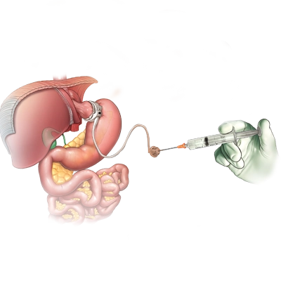 Lap Band Surgery